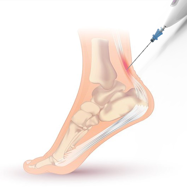 Illustration shows how the Ocelot device can be used to target the Achilles tendon in the heel to promote healing. (Image Courtesy: TendoNova)