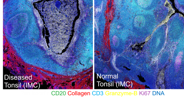 Multiplex bioimaging of human biopsy sample with 35 markers at a time. Distinct tissue architectures reveal the difference between health and disease in an immune tonsil organ. In this example, spatial distributions of different cell types and tissue structure were visualized by different colors: B-cells (CD20), Extracellular matrix (Collagen), T-cells (CD3), Cytotoxic protein (Granzyme-B), Cell proliferation (Ki67).