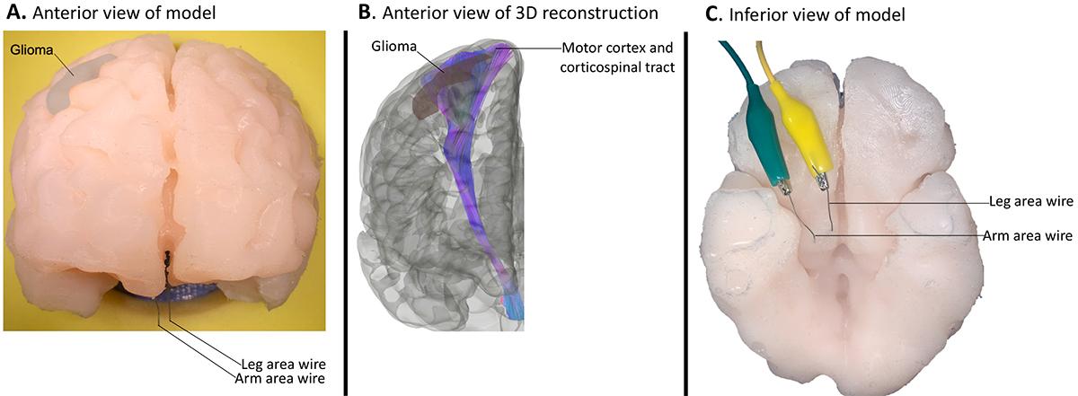 This illustration shows the brain mapping simulator designed by the Brainy Bunch team and reported in the journal Operative Neurosurgery. The simulator is patient-specific, anatomically accurate, and electrically responsive. The middle image is a 3D reconstruction of a magnetic resonance scan that the team used to guide placement of the wires in their model. (Illustration Courtesy: The Brainy Bunch)